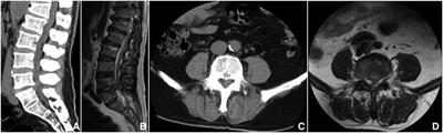 Biportal endoscopic decompression, debridement, and interbody fusion, combined with percutaneous screw fixation for lumbar brucellosis spondylitis